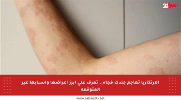 الارتكاريا تهاجم جلدك فجأة.. تعرف على أبرز أعراضها وأسبابها غير المتوقعة